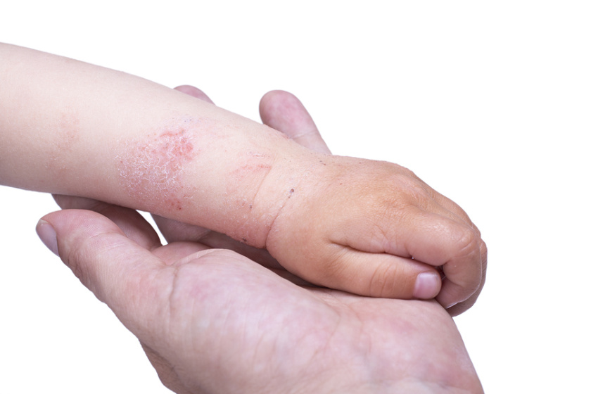 child with eczema on their arm